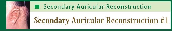 Secondary Auricular Reconstruction #1