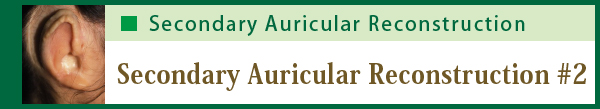 Secondary Auricular Reconstruction #2