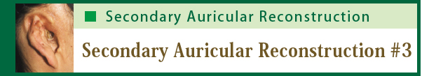 Secondary Auricular Reconstruction #3