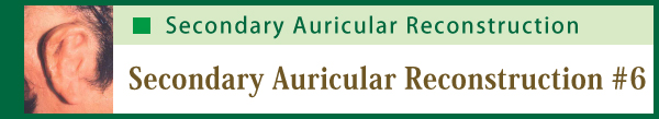 Secondary Auricular Reconstruction #6