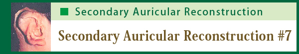 Secondary Auricular Reconstruction #7