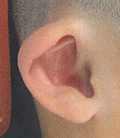 cup ear