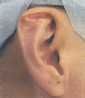 Stahl's Ear
