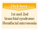 1st and 2st branchial syndrome:Hemifacial microsomia