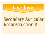 Secondary Auricular Reconstruction #1