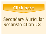 Secondary Auricular Reconstruction #2