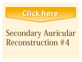 Secondary Auricular Reconstruction #4