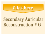 Secondary Auricular Reconstruction #6