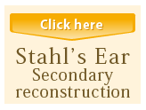 Stahl's Ear Seconfary reconstruction